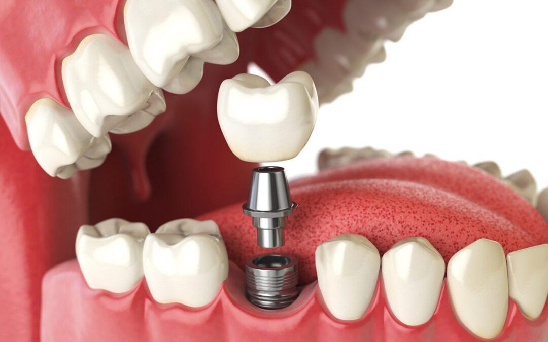 dental implants near me in nyc