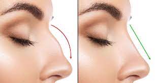 Dubai’s Nose Job Revolution: Unveiling the Secrets of Rhinoplasty for a Droopy Tip!